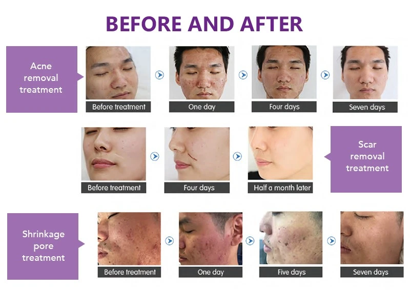 Fractional Co2 Laser Skin Resurfacing Machine Fractional Co2 Laser Skin Resurfacing Machine